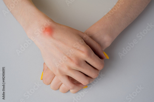 Ganglion cyst on woman hand on white background