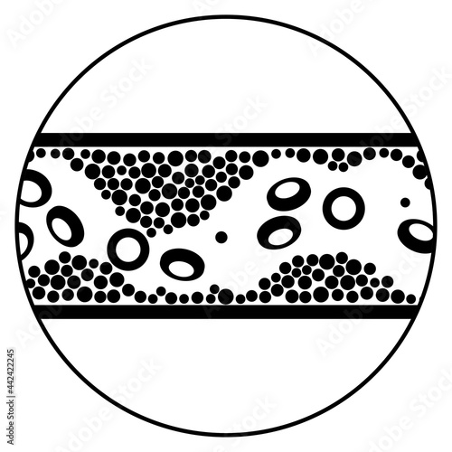 Cholesterol and atherosclerosis