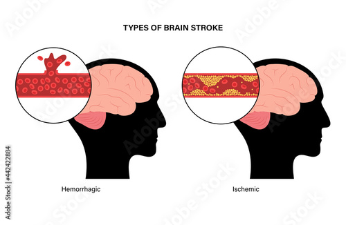 Brain stroke ishemic and hemorrhagic