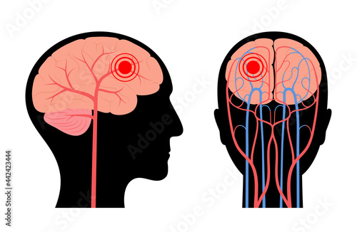 Brain pain disease