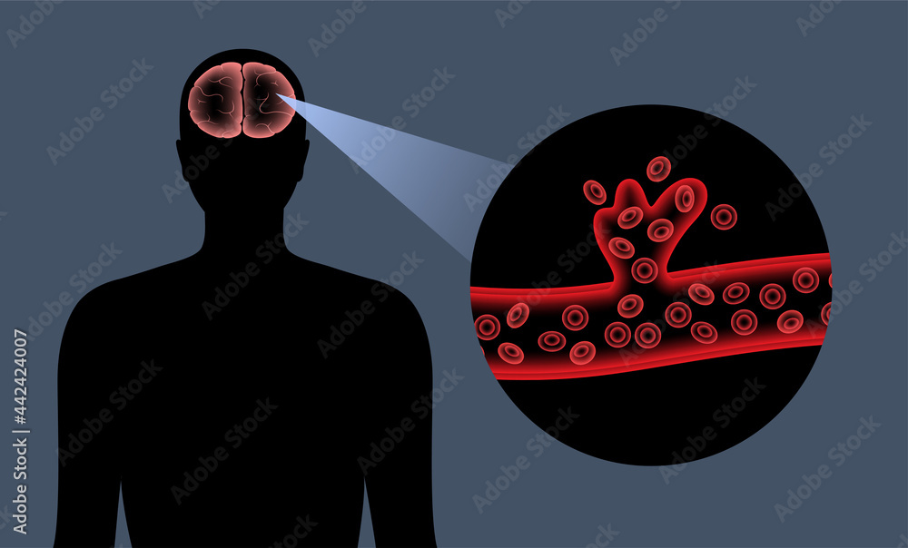 Brain stroke hemorrhagic