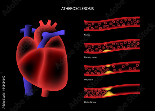 Cholesterol heart disease
