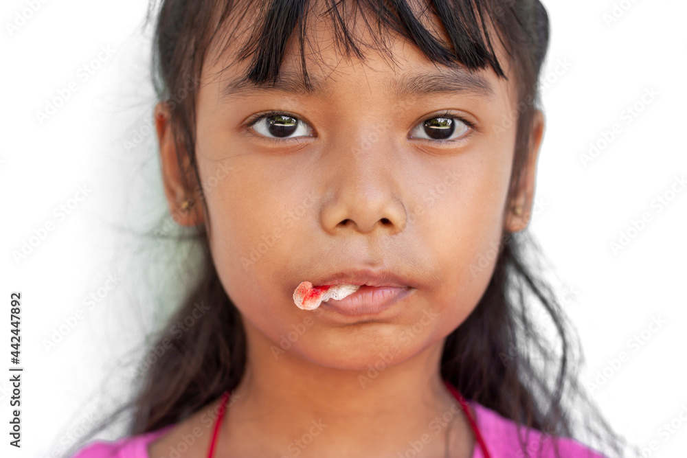 Closeup Asian little girl biting the gauze in mount to stop the