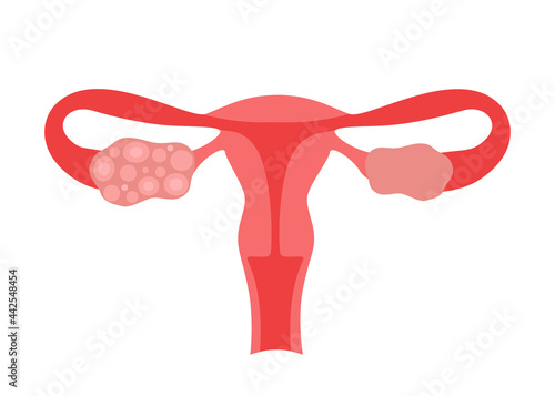 Polycystic ovary syndrome PCOS of woman. Female reproductive system disease. Abnormal uterus internal organ. Vector illustration