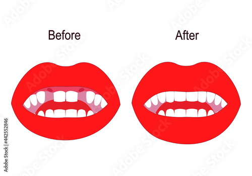 Dental treatment and prosthetics. Teeth before and after the doctor's treatment. The mouth is open. A visual vector illustration