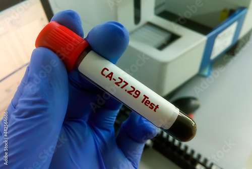 Scientist hold blood sample for CA-27.29 test, diagnosis of breast cancer.