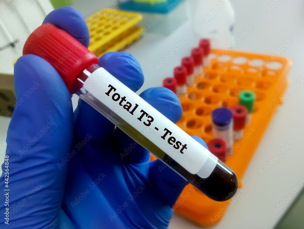 Blood sample in test tube for hormonal examination of thyroid gland in laboratory. Total T3