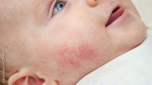 Photo Closeup of baby face skin with pimples and acne from dermatitis