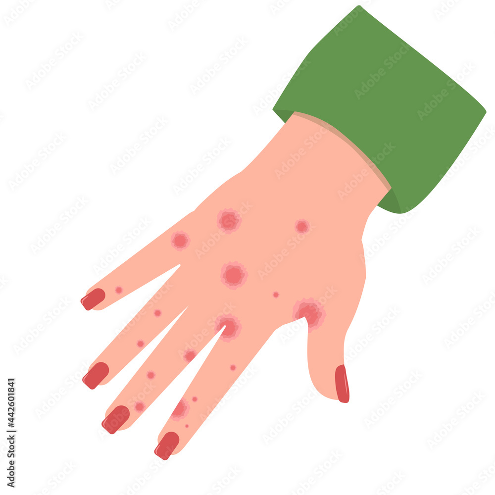 vector illustration of a hand with spots of eczema or contact dermatitis, isolated on a white background vector illustration of a hand with spots of eczema or contact dermatitis, isolated on a white background
