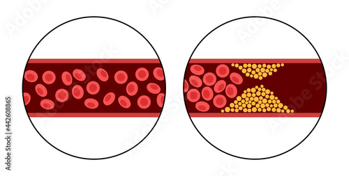 Cholesterol and atherosclerosis