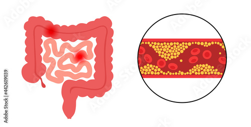 Mesentric ishemia disease