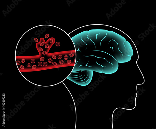 Brain stroke hemorrhagic