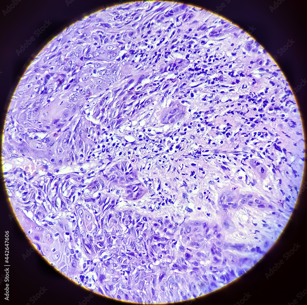 Invasive squamous cell carcinoma of vocal cord polyp.show a malignant ...