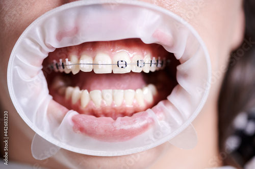 Close up of patient with cheek retractor in mouth demonstrating dental braces on white teeth. Woman with orthodontic wired brackets visiting dental clinic. Concept of orthodontics treatment, dentistry