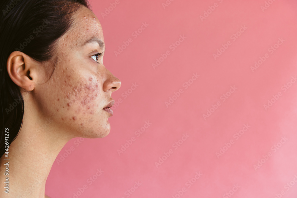 Fototapeta premium Skin disorders may lead to low self esteem in women