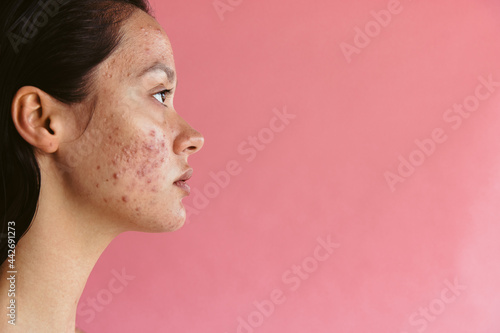 Skin disorders may lead to low self esteem in women photo
