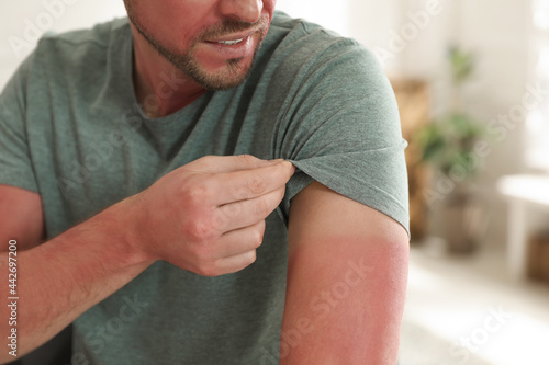 Man with sunburned skin at home, closeup