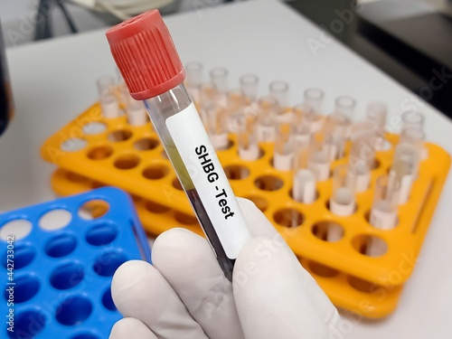Canvas Print Test Tube with blood sample for sex hormone-binding globulin or SHBG test, diagnosis of abnormal testosterone level