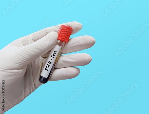 Biochemist or Lab Technologist holds Blood sample for EGFR (estimated glomerular filtration rate) test. Diagnosis of kidney or renal disease test.