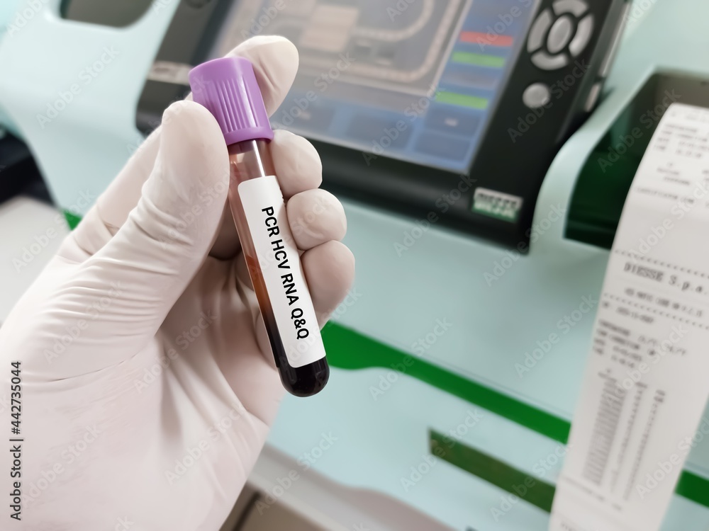 Biochemist or Lab Technologist holds Blood samples for PCR HCV RNA Qualitative and Quantitative (Q and Q) test. Diagnosis of Hepatitis C virus test. Biochemist or Lab Technologist holds Blood samples for PCR HCV RNA Qualitative and Quantitative (Q and Q) test. Diagnosis of Hepatitis C virus test.