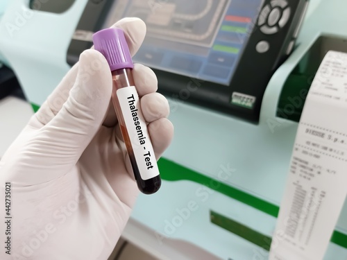 Biochemist or Doctor holds Blood samples for Thalassemia Test (alpha or beta). Hb electrophoresis. Genetically Inheritance disease test in the laboratory background. photo