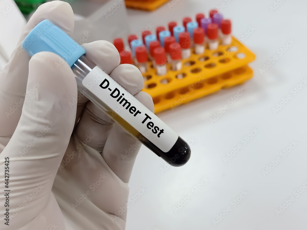 Lab Technologist holds Blood samples for D Dimer test. Corona patient