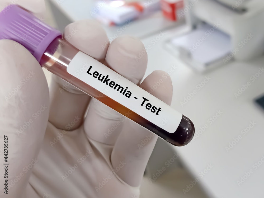 Biochemist or Lab Technologist holds Blood samples for Leukemia test in the laboratory background.
