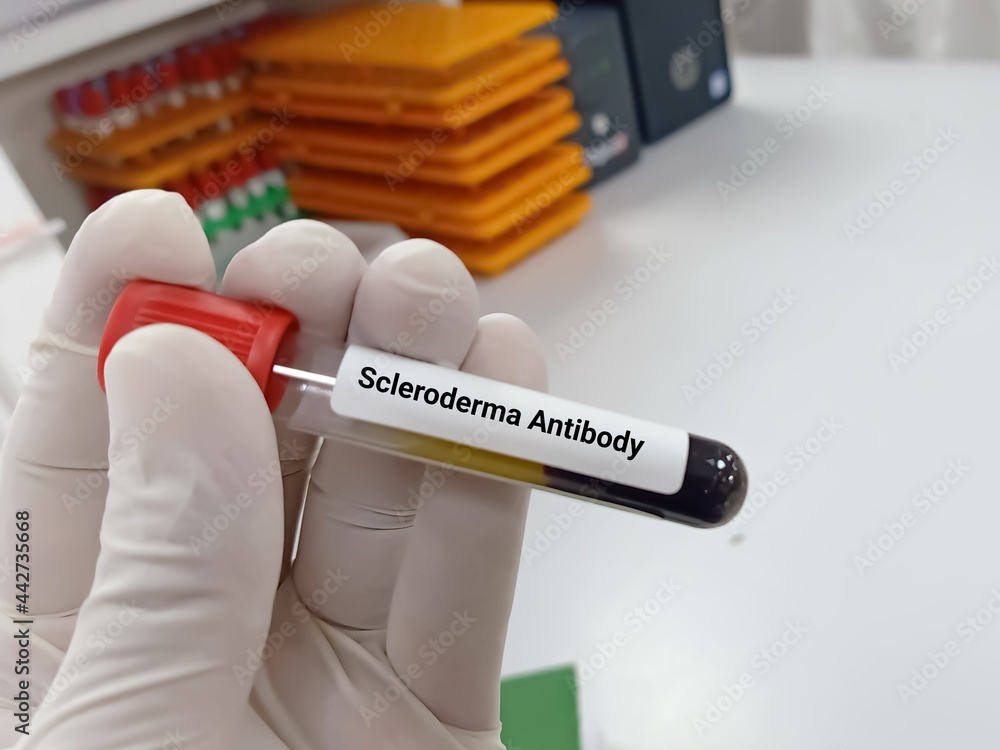 Biochemist or Lab Technologist holds Blood samples for Scleroderma test