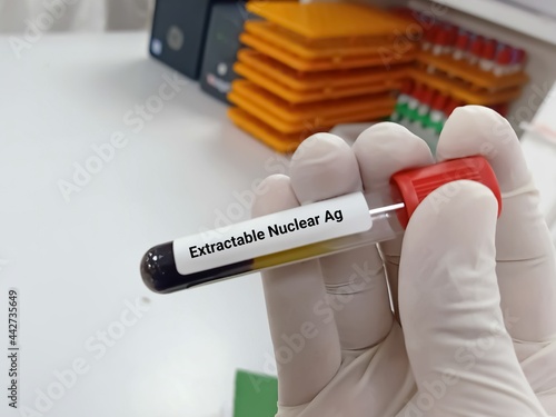 Biochemist holds Blood samples for Extractable nuclear antigen (ENA) test, diagnosis and distinguish between autoimmune disorders as well as to monitor autoimmune disease progression. photo