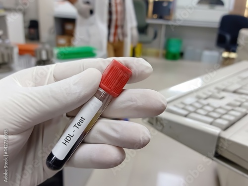 Biochemist or Lab Technologist holds Blood sample for HDL  High-density lipoprotein  test. Lipid profile. Good Cholesterol. Medical testing concept.