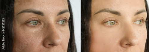woman eyes wrinkles before and after treatment