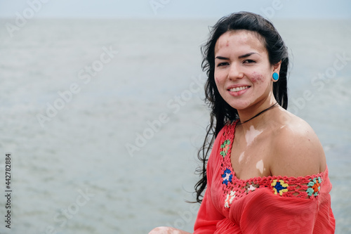 Beautiful latin girl with vitiligo on the beach. World Vitiligo Day. Pigmentation disorders. Skin depigmentation. Chronic skin disease. photo