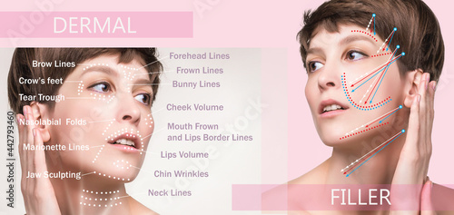 Photography dermal filler treatments in your 40s