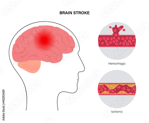 Brain stroke ishemic and hemorrhagic