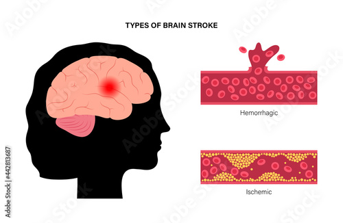 Brain stroke ishemic and hemorrhagic