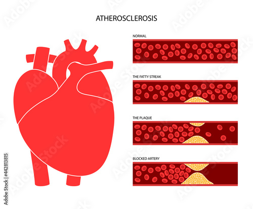 Cholesterol heart disease