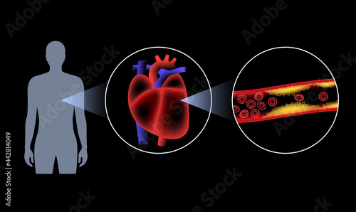 Cholesterol heart disease