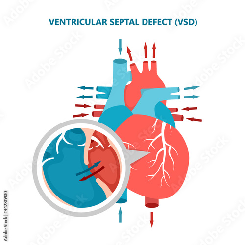 Ventricular septal defect VSD with heart blood flow. Human heart muscle diseases cross-section.