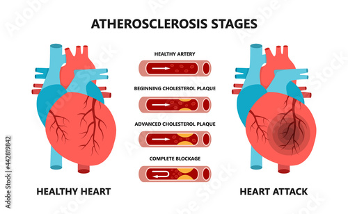 Heart attack and atherosclerosis stages. Healthy and unhealthy arteries. Cholesterol in the blood vessels.
