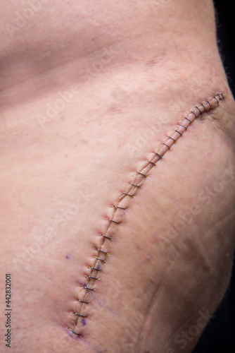Closeup of posterior hip surgery scar with staples. 