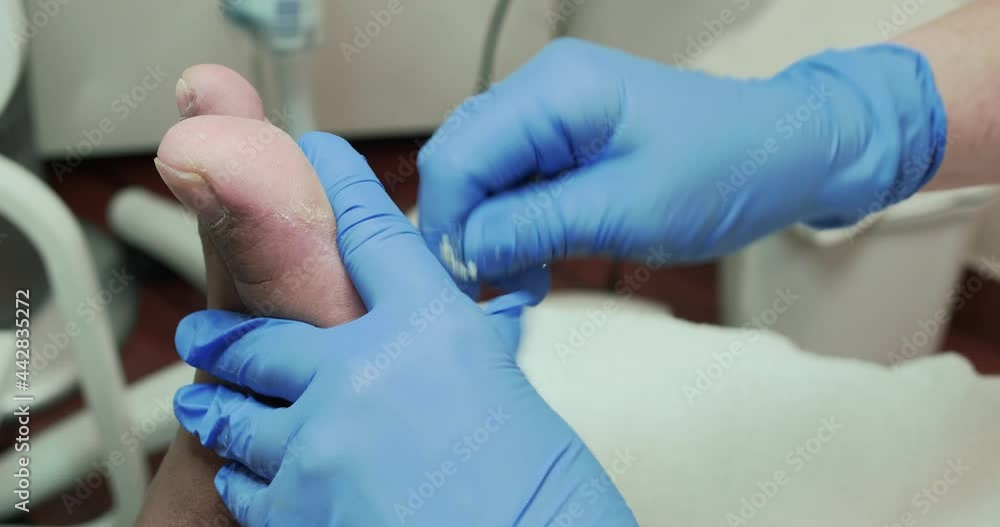 Podiatry cutting dead skin and calluses on the sole of the left foot Podiatry cutting dead skin and calluses on the sole of the left foot