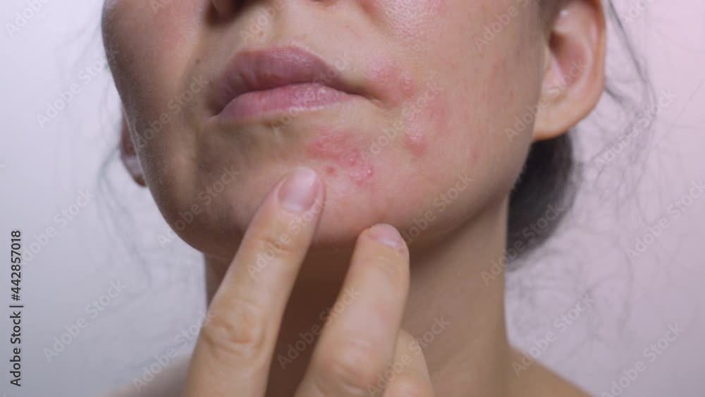 Close-up of a woman's face. Skin texture with a problem on the skin The girl touches the fingers of the problem skin of the face, considering this. Problem skin care concept, allergy Close-up of a woman's face. Skin texture with a problem on the skin The girl touches the fingers of the problem skin of the face, considering this. Problem skin care concept, allergy