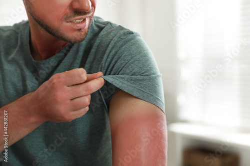 Man with sunburned skin at home, closeup photo