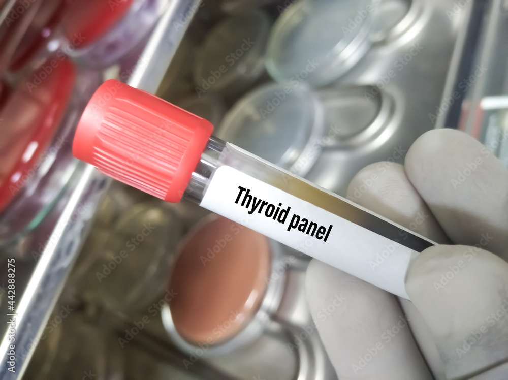 Blood sample in test tube for Thyroid panel test. TSH,T3,T4,FT3,FT4