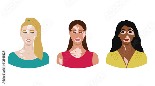 Set of female faces with vitiligo. World Vitiligo Day. Collection of portraits of women with different skin color, hairstyles. Body positive concept. Hand drawn vector illustration.