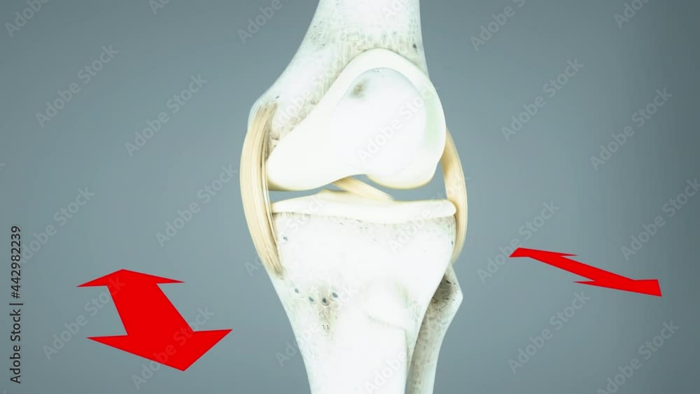 Knee ligament rupture, cruciate ligament rupture, joint instability in