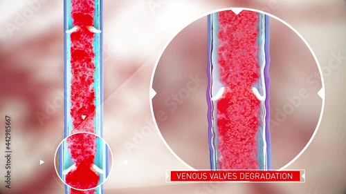 Venous valve dysfunction, degradation of the vein walls, impaired blood flow, Leg vein anatomy, erythrocytes, human anatomy, 3d render photo