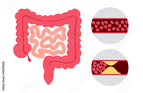 Mesentric ishemia disease