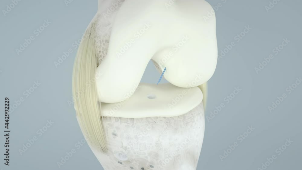 Knee surgery, torn tendon repair, ligament repair, pins, bone drilling