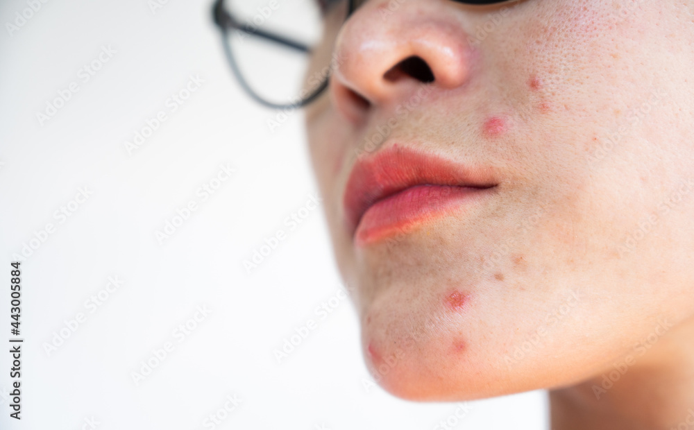 Lower face of woman having acne occur on her lower face. Inflamed acne consists of swelling